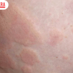 Diseases That Cause Hives in Adults: Understanding the Hidden Health Conditions Behind Chronic Skin Reactions Hives are one of the most common skin conditions experienced by adults. Characterized by raised, itchy, red welts that can appear anywhere on the body, hives may last for a few hours or persist for weeks or even months. While allergic reactions are often considered the primary cause, many people are surprised to learn that several underlying medical conditions can also trigger recurring hives. Understanding the diseases that cause hives in adults is essential for identifying the root cause and receiving appropriate treatment. Persistent or recurring hives should never be ignored, especially when they are accompanied by other symptoms such as joint pain, fever, swelling, or fatigue. This article explores the most common medical conditions associated with adult hives, their symptoms, diagnosis, treatment options, and when it is time to seek medical attention. What Are Hives? Hives, medically known as urticaria, are itchy, raised welts that develop when histamine and other chemicals are released from the skin's mast cells. These welts can vary in size, merge together, and move from one part of the body to another. While acute hives typically resolve within six weeks, chronic hives continue beyond that timeframe and often require a deeper medical evaluation. Although food allergies, medications, insect bites, and environmental triggers are well-known causes, numerous medical disorders can also lead to persistent skin reactions. Common Diseases That Cause Hives in Adults Several underlying health conditions can contribute to chronic or recurring hives. Recognizing these illnesses can help healthcare providers develop an effective treatment plan. 1. Autoimmune Thyroid Disease Autoimmune thyroid disorders such as Hashimoto's thyroiditis and Graves' disease are frequently linked to chronic hives. In these conditions, the immune system mistakenly attacks the thyroid gland, leading to inflammation and hormone imbalance. Many patients experience recurring hives even before thyroid-related symptoms become noticeable. Blood tests evaluating thyroid function and thyroid antibodies are often recommended for adults with unexplained chronic urticaria. Autoimmune thyroid disease is among the most recognized diseases that cause hives in adults, making thyroid screening an important part of diagnosis. 2. Lupus Systemic Lupus Erythematosus (SLE) is a chronic autoimmune disease affecting multiple organs, including the skin. People with lupus may develop persistent hives along with fatigue, joint pain, facial rashes, kidney problems, and sensitivity to sunlight. Because lupus causes widespread immune system dysfunction, skin manifestations like hives may become a recurring symptom during disease flare-ups. 3. Rheumatoid Arthritis Although primarily known as a joint disease, rheumatoid arthritis can also affect the skin. Chronic inflammation associated with this autoimmune disorder may contribute to recurrent hives in some individuals. Patients experiencing joint stiffness together with persistent hives should consult a healthcare professional for a comprehensive evaluation. 4. Viral Infections Many viral infections can trigger temporary hives by activating the immune system. Common examples include: Hepatitis B Hepatitis C Epstein-Barr virus COVID-19 Influenza In some cases, hives may appear before other symptoms develop, making them an early sign of infection. Viral illnesses are among the temporary diseases that cause hives in adults, especially when the immune response is particularly strong. 5. Chronic Bacterial Infections Certain long-term bacterial infections can also stimulate ongoing immune responses that lead to chronic hives. Examples include: Helicobacter pylori infection Dental infections Chronic sinus infections Urinary tract infections Treating the underlying infection often helps reduce or eliminate recurring skin symptoms. 6. Vasculitis Urticarial vasculitis is a rare condition where inflammation affects small blood vessels instead of the skin alone. Unlike ordinary hives, these lesions often remain in the same location for more than 24 hours and may leave bruising or discoloration after healing. People with vasculitis may also experience fever, abdominal pain, joint pain, or kidney involvement, requiring specialist care. Other Medical Conditions Associated with Hives Besides autoimmune diseases and infections, several additional health conditions may contribute to chronic hives: Diabetes-related autoimmune disorders Certain blood cancers Hormonal disorders Chronic kidney disease Liver disease Mast cell disorders Although less common, these illnesses highlight why persistent hives should always receive proper medical assessment. How Doctors Diagnose the Underlying Cause Diagnosing chronic hives involves more than examining the skin. Healthcare providers typically review medical history, current medications, family history, and accompanying symptoms. Diagnostic tests may include: Complete blood count (CBC) Thyroid function tests Autoimmune antibody testing Liver and kidney function tests Infection screening Allergy testing when appropriate Skin biopsy in selected cases Because many diseases that cause hives in adults involve immune system abnormalities, identifying the correct diagnosis may require consultation with dermatologists, allergists, or rheumatologists. Treatment Options Treatment depends on the underlying cause rather than simply relieving the itching. Common management strategies include: Antihistamines Non-drowsy antihistamines are usually the first-line treatment for controlling itching and reducing hive formation. Corticosteroids Short courses of oral steroids may be prescribed during severe flare-ups but are generally not recommended for long-term use. Biologic Therapy For chronic spontaneous urticaria that does not respond to antihistamines, biologic medications may help control symptoms by targeting immune pathways. Treating the Underlying Disease Managing thyroid disorders, autoimmune diseases, infections, or other medical conditions often significantly improves chronic hives. Lifestyle adjustments, stress management, avoiding known triggers, and following treatment plans are equally important components of long-term care. When Should You See a Doctor? Occasional hives that disappear within a day are usually not a cause for concern. However, medical evaluation is recommended if hives: Last longer than six weeks Recur frequently Are associated with fever or joint pain Cause facial or throat swelling Interfere with sleep or daily activities Do not respond to over-the-counter antihistamines Emergency medical attention is necessary if hives occur alongside difficulty breathing, dizziness, swelling of the tongue, or signs of anaphylaxis. Can Chronic Hives Be Prevented? Not all chronic hives can be prevented, especially when linked to autoimmune diseases. However, certain habits may reduce flare-ups: Follow prescribed treatment plans. Avoid known allergens and triggers. Manage stress through relaxation techniques. Maintain good sleep habits. Treat infections promptly. Schedule regular medical checkups for chronic illnesses. While prevention may not always be possible, proper disease management often reduces the frequency and severity of symptoms. Conclusion Hives are more than just an allergic skin reaction. In many cases, they serve as an important clue that an underlying medical condition may be affecting the immune system. From autoimmune thyroid disorders and lupus to chronic infections and vasculitis, numerous diseases that cause hives in adults can contribute to persistent or recurring outbreaks. Recognizing these conditions early allows for timely diagnosis, appropriate treatment, and better long-term outcomes. If hives continue for several weeks or repeatedly return without an obvious trigger, seeking medical evaluation is essential. Rather than treating the symptoms alone, identifying and addressing the underlying disease offers the best chance for lasting relief and improved overall health.