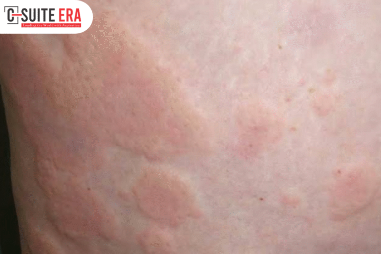 Diseases That Cause Hives in Adults: Understanding the Hidden Health Conditions Behind Chronic Skin Reactions Hives are one of the most common skin conditions experienced by adults. Characterized by raised, itchy, red welts that can appear anywhere on the body, hives may last for a few hours or persist for weeks or even months. While allergic reactions are often considered the primary cause, many people are surprised to learn that several underlying medical conditions can also trigger recurring hives. Understanding the diseases that cause hives in adults is essential for identifying the root cause and receiving appropriate treatment. Persistent or recurring hives should never be ignored, especially when they are accompanied by other symptoms such as joint pain, fever, swelling, or fatigue. This article explores the most common medical conditions associated with adult hives, their symptoms, diagnosis, treatment options, and when it is time to seek medical attention. What Are Hives? Hives, medically known as urticaria, are itchy, raised welts that develop when histamine and other chemicals are released from the skin's mast cells. These welts can vary in size, merge together, and move from one part of the body to another. While acute hives typically resolve within six weeks, chronic hives continue beyond that timeframe and often require a deeper medical evaluation. Although food allergies, medications, insect bites, and environmental triggers are well-known causes, numerous medical disorders can also lead to persistent skin reactions. Common Diseases That Cause Hives in Adults Several underlying health conditions can contribute to chronic or recurring hives. Recognizing these illnesses can help healthcare providers develop an effective treatment plan. 1. Autoimmune Thyroid Disease Autoimmune thyroid disorders such as Hashimoto's thyroiditis and Graves' disease are frequently linked to chronic hives. In these conditions, the immune system mistakenly attacks the thyroid gland, leading to inflammation and hormone imbalance. Many patients experience recurring hives even before thyroid-related symptoms become noticeable. Blood tests evaluating thyroid function and thyroid antibodies are often recommended for adults with unexplained chronic urticaria. Autoimmune thyroid disease is among the most recognized diseases that cause hives in adults, making thyroid screening an important part of diagnosis. 2. Lupus Systemic Lupus Erythematosus (SLE) is a chronic autoimmune disease affecting multiple organs, including the skin. People with lupus may develop persistent hives along with fatigue, joint pain, facial rashes, kidney problems, and sensitivity to sunlight. Because lupus causes widespread immune system dysfunction, skin manifestations like hives may become a recurring symptom during disease flare-ups. 3. Rheumatoid Arthritis Although primarily known as a joint disease, rheumatoid arthritis can also affect the skin. Chronic inflammation associated with this autoimmune disorder may contribute to recurrent hives in some individuals. Patients experiencing joint stiffness together with persistent hives should consult a healthcare professional for a comprehensive evaluation. 4. Viral Infections Many viral infections can trigger temporary hives by activating the immune system. Common examples include: Hepatitis B Hepatitis C Epstein-Barr virus COVID-19 Influenza In some cases, hives may appear before other symptoms develop, making them an early sign of infection. Viral illnesses are among the temporary diseases that cause hives in adults, especially when the immune response is particularly strong. 5. Chronic Bacterial Infections Certain long-term bacterial infections can also stimulate ongoing immune responses that lead to chronic hives. Examples include: Helicobacter pylori infection Dental infections Chronic sinus infections Urinary tract infections Treating the underlying infection often helps reduce or eliminate recurring skin symptoms. 6. Vasculitis Urticarial vasculitis is a rare condition where inflammation affects small blood vessels instead of the skin alone. Unlike ordinary hives, these lesions often remain in the same location for more than 24 hours and may leave bruising or discoloration after healing. People with vasculitis may also experience fever, abdominal pain, joint pain, or kidney involvement, requiring specialist care. Other Medical Conditions Associated with Hives Besides autoimmune diseases and infections, several additional health conditions may contribute to chronic hives: Diabetes-related autoimmune disorders Certain blood cancers Hormonal disorders Chronic kidney disease Liver disease Mast cell disorders Although less common, these illnesses highlight why persistent hives should always receive proper medical assessment. How Doctors Diagnose the Underlying Cause Diagnosing chronic hives involves more than examining the skin. Healthcare providers typically review medical history, current medications, family history, and accompanying symptoms. Diagnostic tests may include: Complete blood count (CBC) Thyroid function tests Autoimmune antibody testing Liver and kidney function tests Infection screening Allergy testing when appropriate Skin biopsy in selected cases Because many diseases that cause hives in adults involve immune system abnormalities, identifying the correct diagnosis may require consultation with dermatologists, allergists, or rheumatologists. Treatment Options Treatment depends on the underlying cause rather than simply relieving the itching. Common management strategies include: Antihistamines Non-drowsy antihistamines are usually the first-line treatment for controlling itching and reducing hive formation. Corticosteroids Short courses of oral steroids may be prescribed during severe flare-ups but are generally not recommended for long-term use. Biologic Therapy For chronic spontaneous urticaria that does not respond to antihistamines, biologic medications may help control symptoms by targeting immune pathways. Treating the Underlying Disease Managing thyroid disorders, autoimmune diseases, infections, or other medical conditions often significantly improves chronic hives. Lifestyle adjustments, stress management, avoiding known triggers, and following treatment plans are equally important components of long-term care. When Should You See a Doctor? Occasional hives that disappear within a day are usually not a cause for concern. However, medical evaluation is recommended if hives: Last longer than six weeks Recur frequently Are associated with fever or joint pain Cause facial or throat swelling Interfere with sleep or daily activities Do not respond to over-the-counter antihistamines Emergency medical attention is necessary if hives occur alongside difficulty breathing, dizziness, swelling of the tongue, or signs of anaphylaxis. Can Chronic Hives Be Prevented? Not all chronic hives can be prevented, especially when linked to autoimmune diseases. However, certain habits may reduce flare-ups: Follow prescribed treatment plans. Avoid known allergens and triggers. Manage stress through relaxation techniques. Maintain good sleep habits. Treat infections promptly. Schedule regular medical checkups for chronic illnesses. While prevention may not always be possible, proper disease management often reduces the frequency and severity of symptoms. Conclusion Hives are more than just an allergic skin reaction. In many cases, they serve as an important clue that an underlying medical condition may be affecting the immune system. From autoimmune thyroid disorders and lupus to chronic infections and vasculitis, numerous diseases that cause hives in adults can contribute to persistent or recurring outbreaks. Recognizing these conditions early allows for timely diagnosis, appropriate treatment, and better long-term outcomes. If hives continue for several weeks or repeatedly return without an obvious trigger, seeking medical evaluation is essential. Rather than treating the symptoms alone, identifying and addressing the underlying disease offers the best chance for lasting relief and improved overall health.
